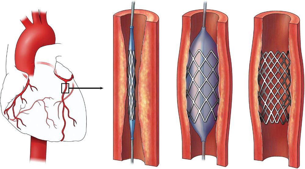Coronary Angioplastry